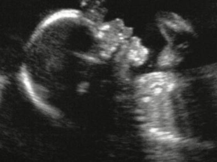 baby-scan-abortion-main_article_image.jpg