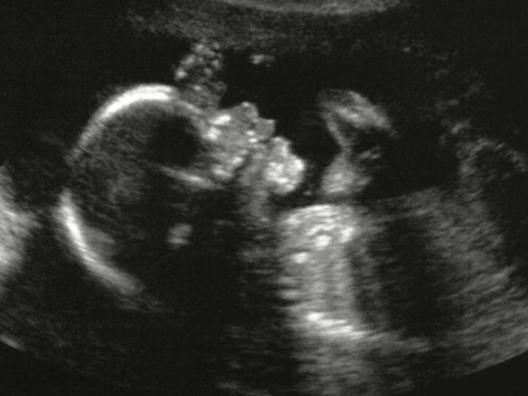 baby-scan-abortion-thumb_galleryfull.jpg