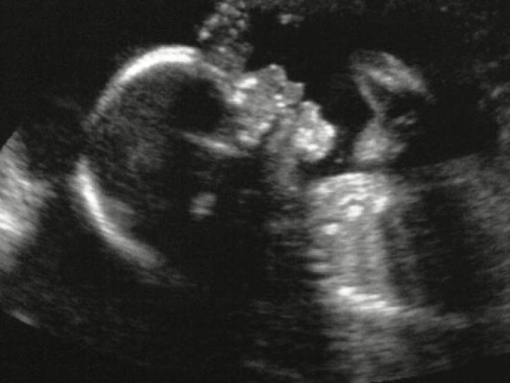 baby-scan-abortion-main_galleryfull.jpg