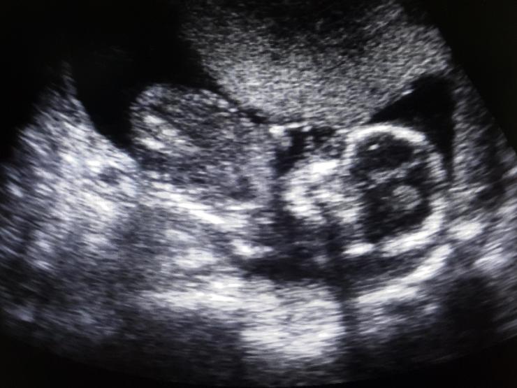 scan feotus.jpg